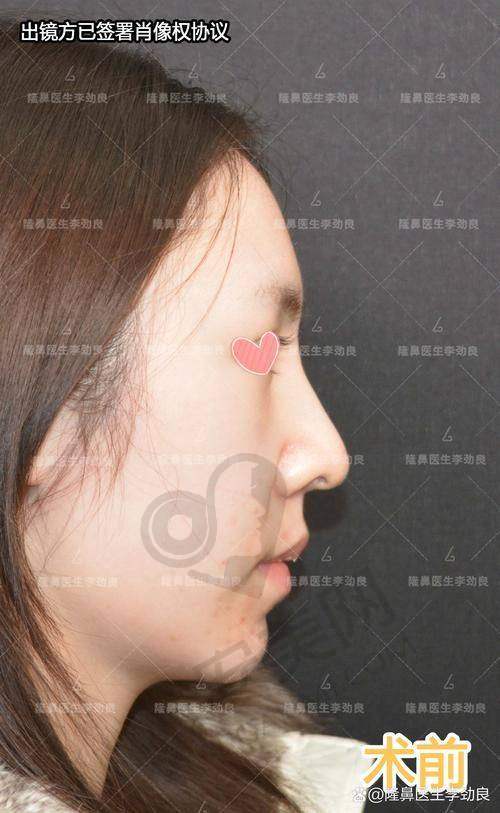 成都友谊整形医院隆鼻整形失败修复价格是如何确定的？