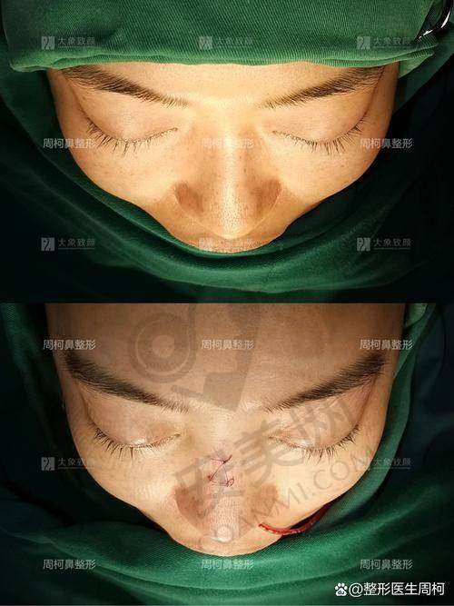 隆鼻整形失败修复后如何护理？