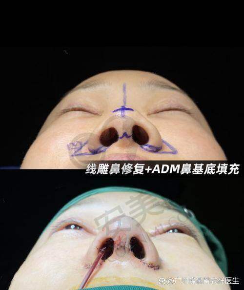 成都友谊整形医院隆鼻整形失败修复成功实例多吗？
