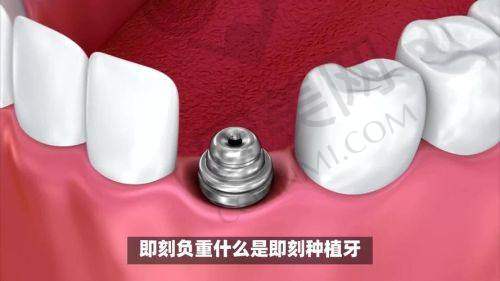 上海松丰齿科数字化即拔即种技术的术后护理需要注意什么？