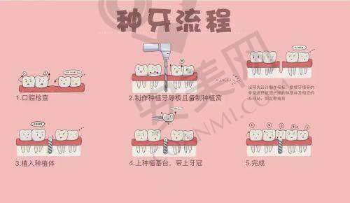 上海松丰齿科数字化即拔即种技术有哪些优势？