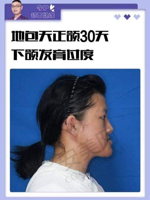 佩戴矫正器：过程痛苦吗？