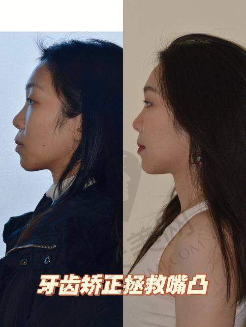 凸嘴矫正后能达到怎样的成效？