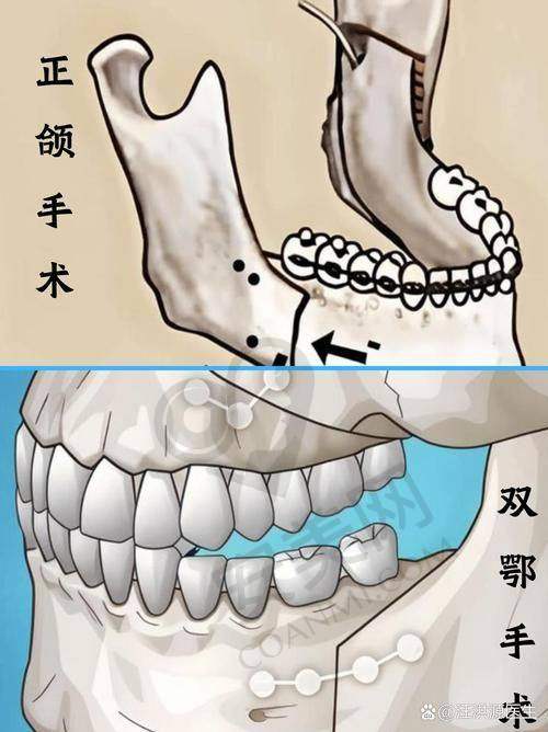 凸嘴矫正的过程是怎样的？