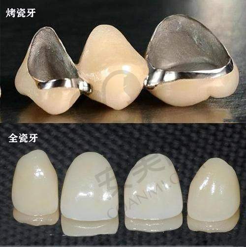 国产爱尔创全瓷牙冠是什么？