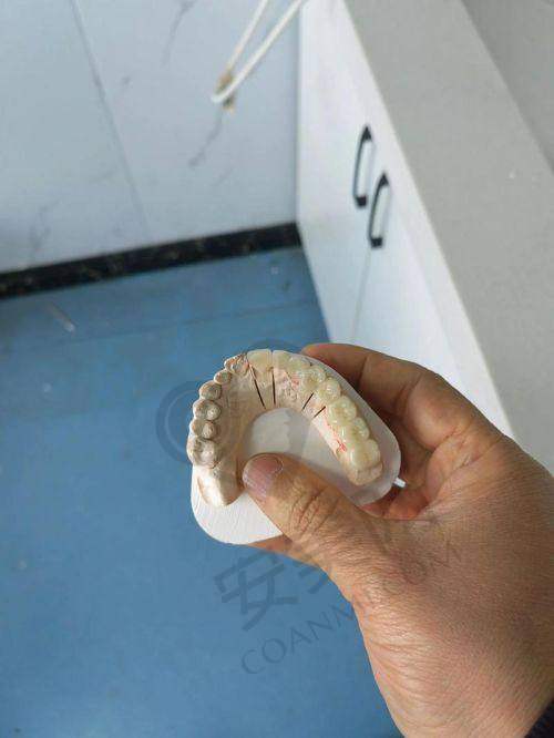 全瓷牙安装：见证牙齿的蜕变