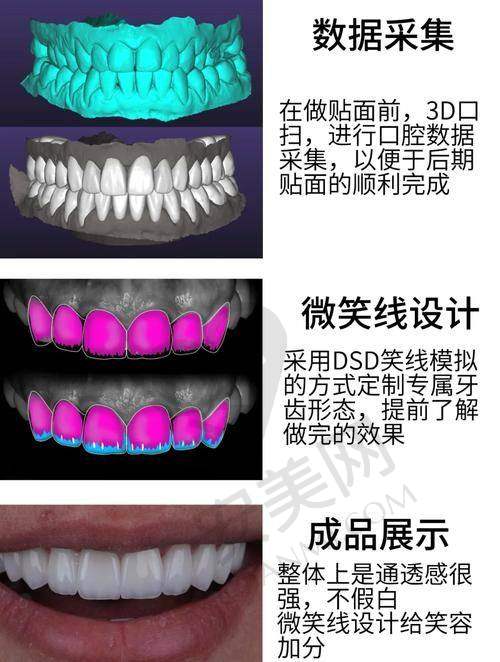 为什么选择深圳美莱口腔进行牙齿贴面美白？