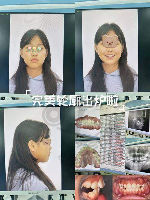 东莞国贸口腔医院的澳洲MRC肌功能矫治有什么优势？