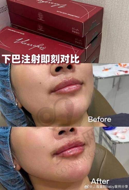 西安晶肤美容医院玻尿酸塑形价格是怎样的？