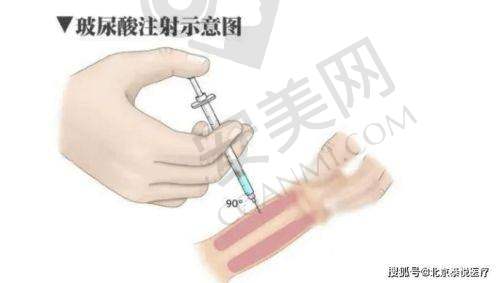 西安晶肤美容医院玻尿酸塑形后需要注意什么？