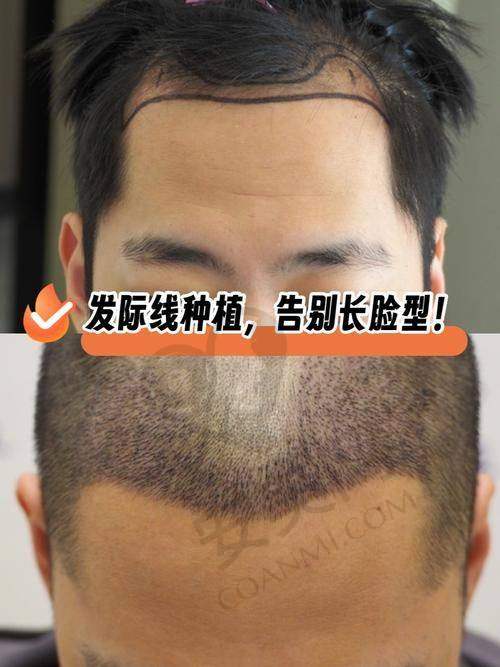 成都大麦医院发际线不剃发种植的流程是怎样的？