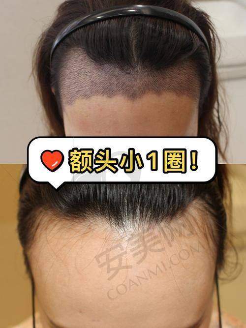 哪些人适合成都大麦医院的发际线不剃发种植？