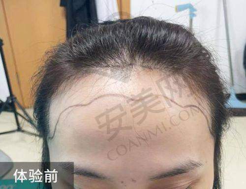 成都大麦医院发际线不剃发种植的优势有哪些？