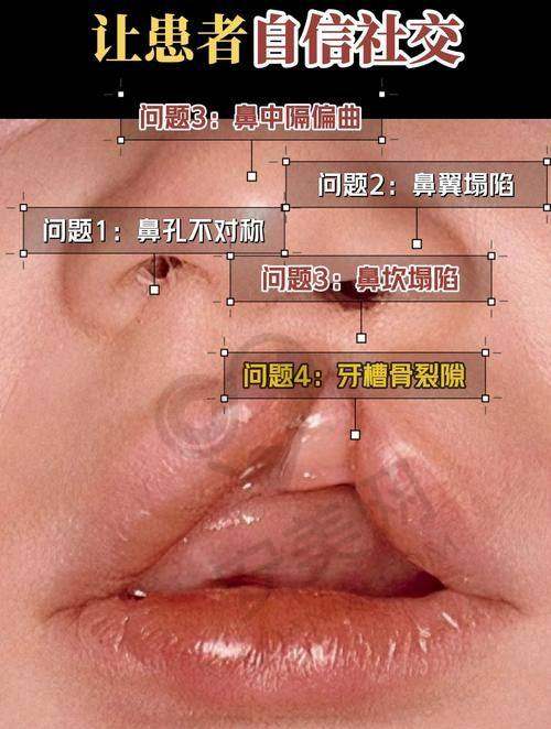 广州高尚医院唇腭裂修复技术有多精良？