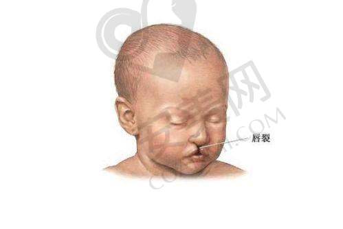 如何预约广州高尚医院的唇腭裂修复手术？