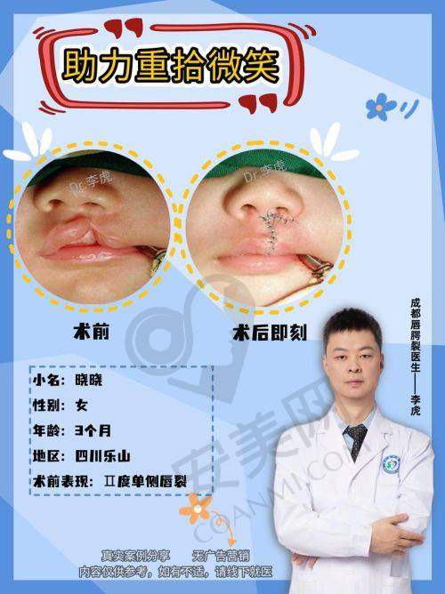 修复唇裂后对生活有什么改变？