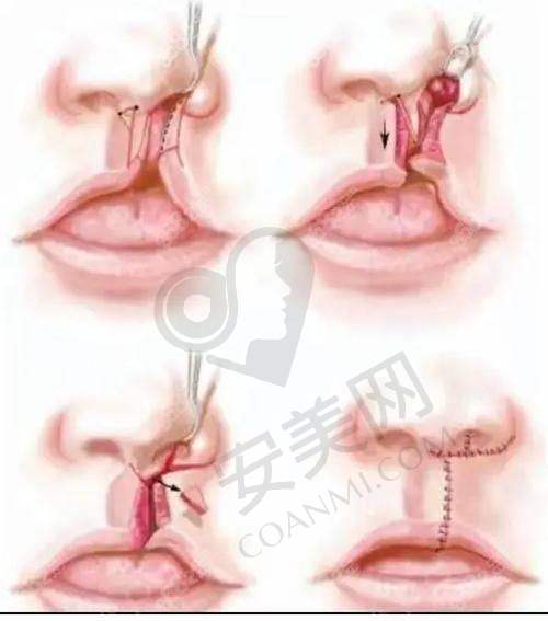唇腭裂修复后能修复到什么程度？