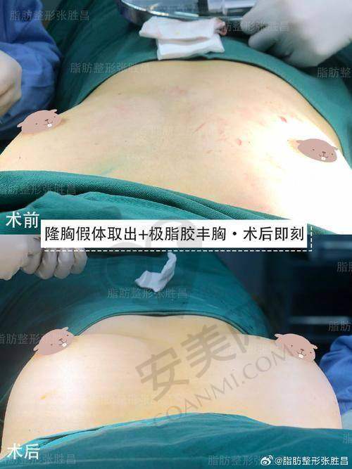 武汉仁爱时光脂肪隆胸，靠谱吗？