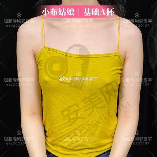 武汉仁爱时光自体脂肪丰胸的术后护理重要吗？