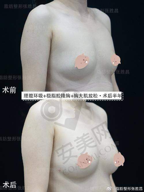武汉仁爱时光脂肪隆胸，手术过程是怎样的？