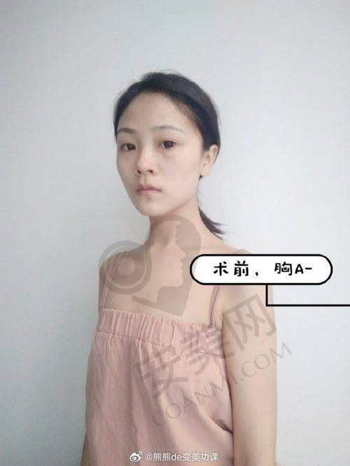 选择武汉仁爱时光自体脂肪丰胸有保护吗？