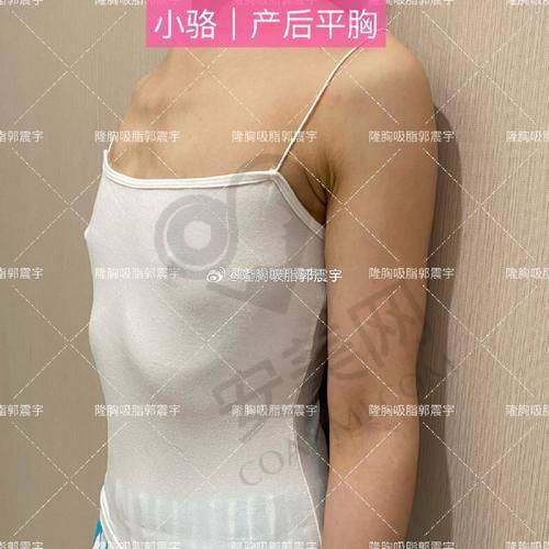 武汉仁爱时光脂肪隆胸，术前要做哪些准备？