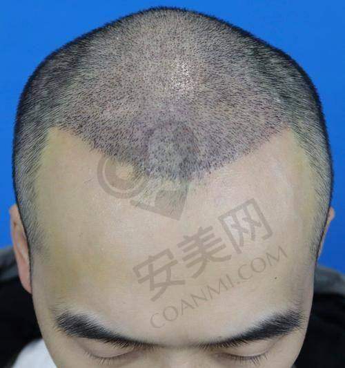 在成都大麦医院进行发际线不剃发种植安心吗？
