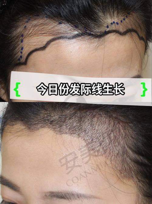 成都大麦医院发际线不剃发种植的价格是如何确定的？
