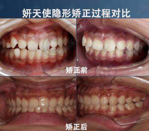 隐形矫正器的佩戴体验如何？