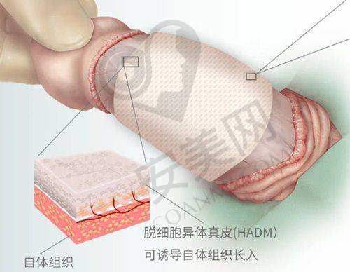 面部双美胶原蛋白填充适合哪些人？