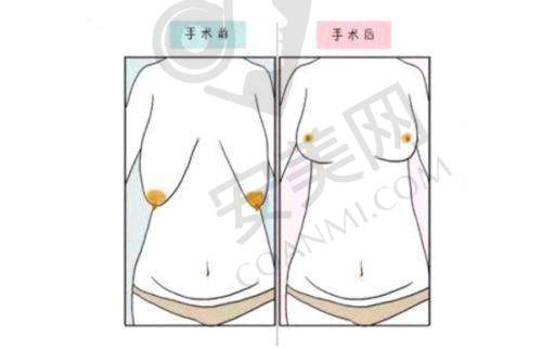 眼部整形热门项目及价格