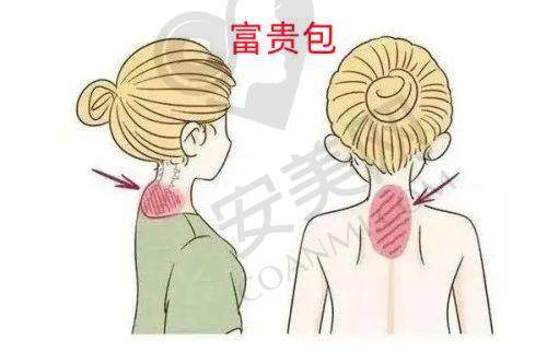 面部双美胶原蛋白填充有哪些优势？