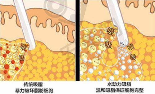 广州吕方中修复双眼皮的价格如何？
