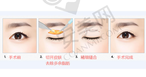 什么是“童龄扣”筋膜悬吊提升？