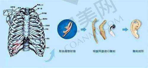 耳再造手术的流程和注意事项