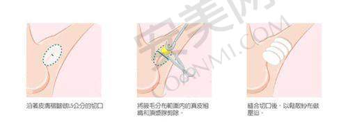 祛黑色素斑后肌肤能有哪些改善？