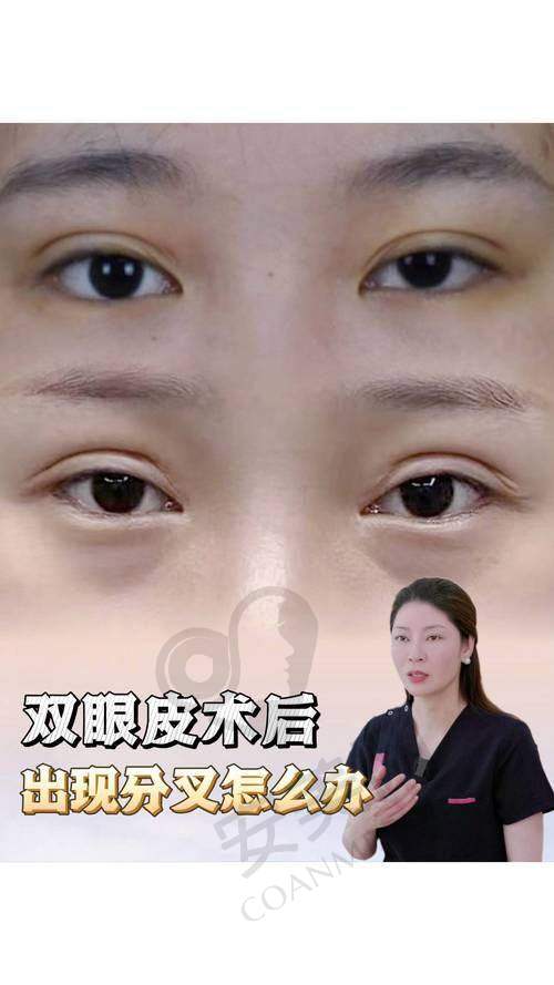 如何预约吕方中医生的双眼皮修复手术？