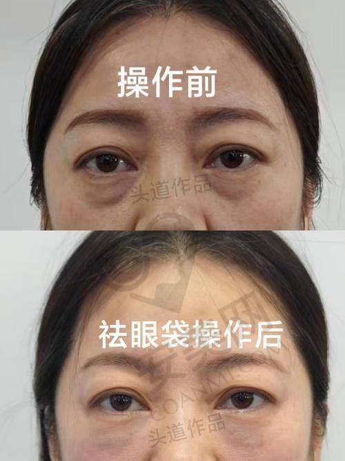 术后护理：保持成效的关键