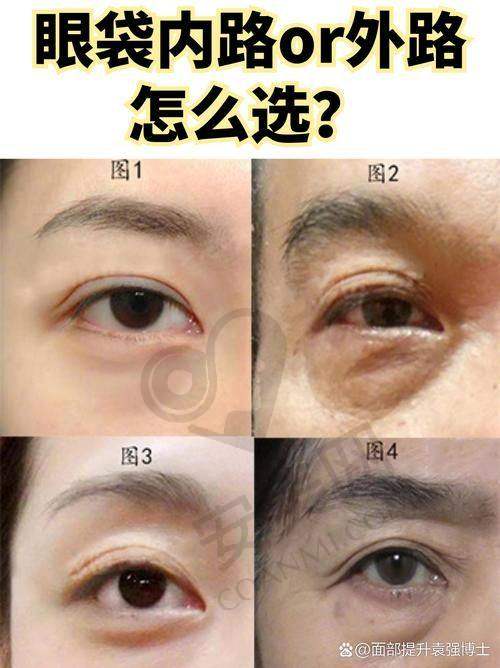 不同去眼袋方法价格差异大吗？
