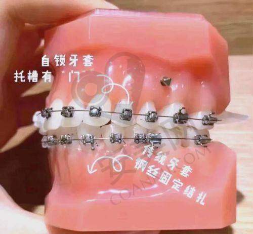 传统金属托槽矫正有哪些优势？