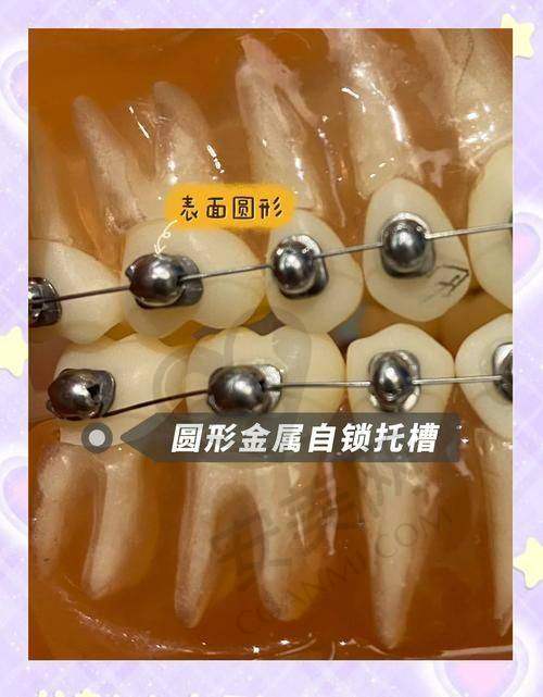 传统金属托槽矫正的成效能维持多久？