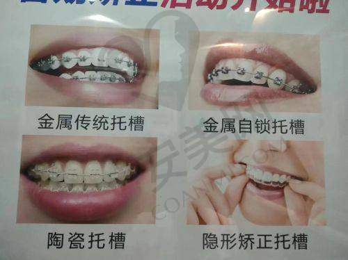 郑州德韩口腔陶瓷自锁矫正有哪些优势？