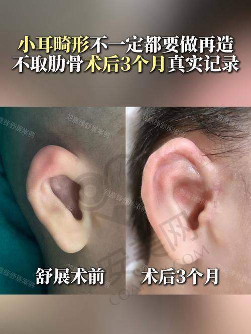耳再造手术的重要意义