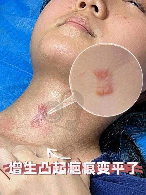 合肥台美丽格整形：平价祛疤赢口碑
