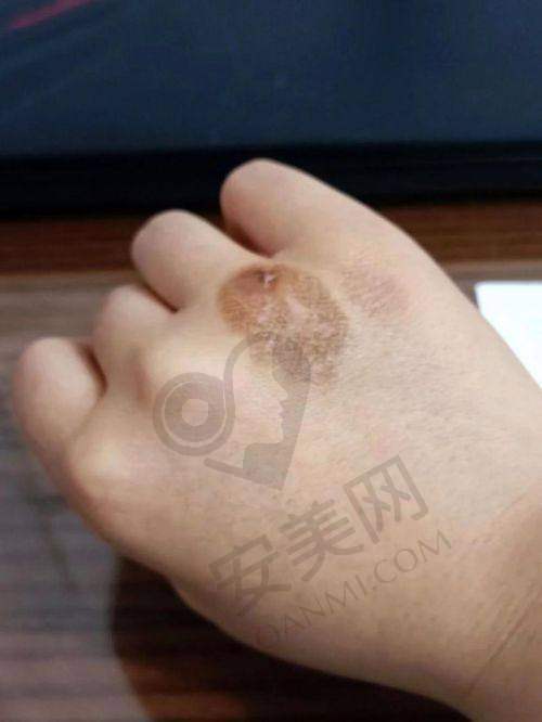 合肥壹加壹美容医院：多元化祛疤的优选之选