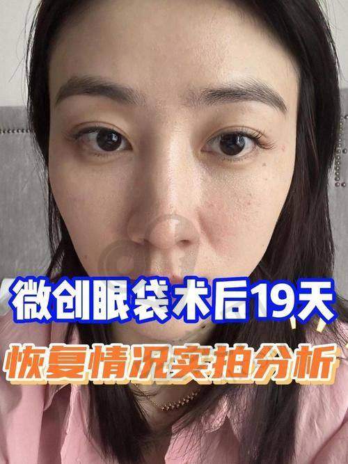 为什么选择深圳美莱祛眼袋？