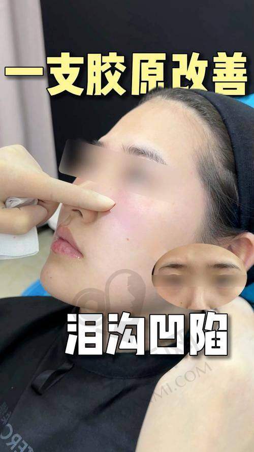 弗缦胶原蛋白填充的价格优势