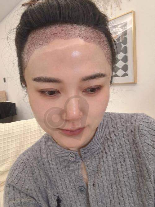 天津雍禾植发：国内连锁的优质品牌