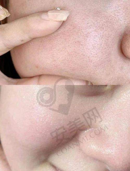 总结：沈阳杏林打水光针，值得尝试吗？