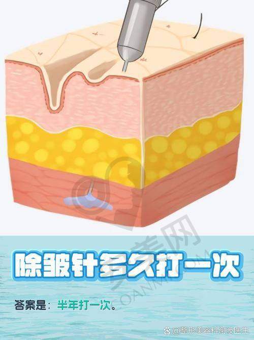 医生是如何为我定制除皱方案的？